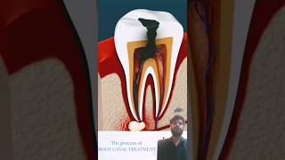 Root Canal Treatment amp Tooth Abscess shots [upl. by Llehcar65]