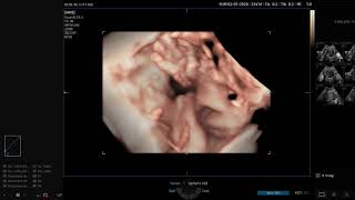 Ecografía obstétrica tomada durante una capacitación de manejo con el v6 de Samsung [upl. by Tijnar]