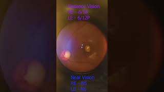 Retinal Fundus Recording  Smartphone Fundus camera [upl. by Lemieux451]