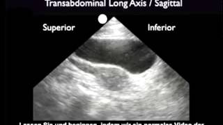 Anleitung FASTUntersuchung – suprapubische Darstellungen [upl. by Etnoid682]