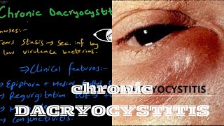 Chronic Dacryocystitis  lacrimal system [upl. by Bahe]