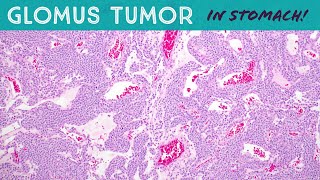 Glomus Tumor in STOMACHsoft tissue pathology gastricgastrointestinal tumor [upl. by Yeuh]