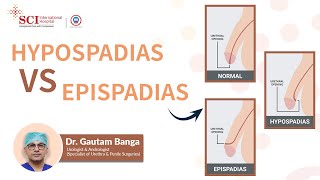 Hypospadias vs Epispadias  Dr Gautam Banga  SCI Hospital [upl. by Meeka]