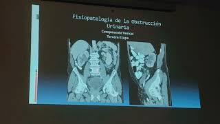 HIPERPLASIA PROSTÁTICA BENIGNA GENERALIDADES DIAGNOSTICO Y TRATAMIENTO [upl. by Eilema]