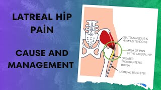 greater trochanteric pain syndrome gluteal tendinopathy lateral hip pain GTPS [upl. by Adniral]