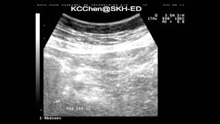 Epiploic appendagitis [upl. by Ruenhcs]