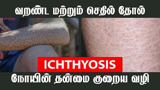 ICHTHYOSIS நோயின் தன்மை குறைய வழி  JKT SKIN [upl. by Dionne]