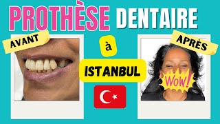 IMPLANTS DENTAIRES AVANT APRÈS à Istanbul je vous explique tout [upl. by Finah]