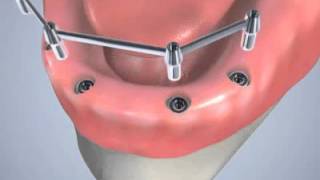 Prothèse dentaire sur implants [upl. by Aehs]