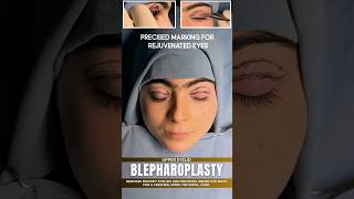 Brighten Your Eyes with Blepharoplasty  Sarayu Clinics beauty [upl. by Wertz]