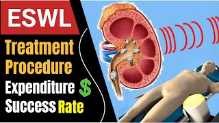 Extracorporeal Shock Wave Lithotripsy In Hindi  Lithotripsy Treatment For Kidney Stone In Hindi [upl. by Morie]