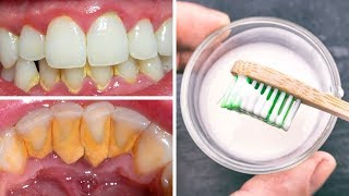 Remove Tartar From Teeth With A Recipe Your Dentist Will Never Tell You [upl. by Levania]