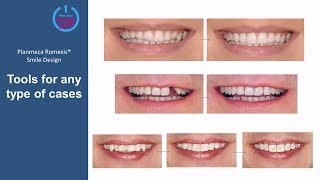 Planmeca Romexis® Smile Design Webinar – how to design realistic smiles [upl. by Alahcim431]