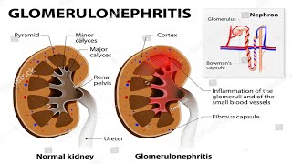 what is Nephritis glomerulonephritis glomerulonephritis treatment [upl. by Ahtreb]