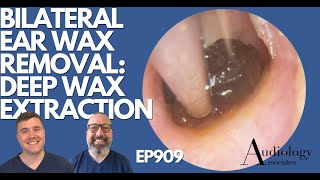 BILATERAL EAR WAX REMOVAL DEEP WAX EXTRACTION  EP909 [upl. by Sellers]