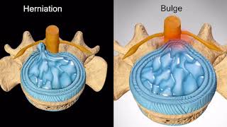 Disc Bulge vs Disc Herniation [upl. by Assirral]