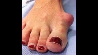 Crazy Tips for the FASTEST Possible Bunion Surgery Recovery [upl. by Kay]