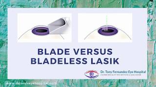 Blade versus Bladeless LASIK [upl. by Ydnir257]