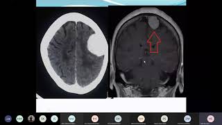 meningioma and classification of CNS tumors [upl. by Drof]