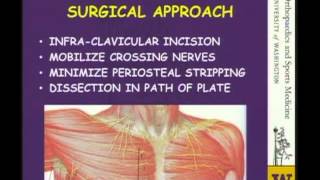 Clavicle Fractures Controversies [upl. by Key]