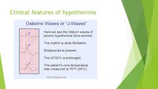 Hypothermia Clinical features classification investigation and management [upl. by Skilken]