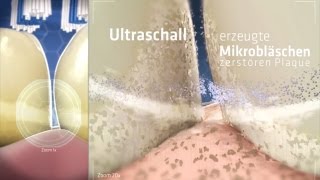 So funktioniert die Zahnreinigung mit echtem Ultraschall  emmident [upl. by Lamond439]