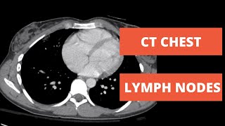 Lymph Nodes Stations of the Chest on CT [upl. by Brufsky]