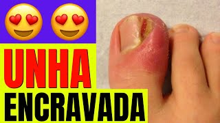 Podologia em vídeos de UNHAS ENCRAVADAS [upl. by Bixby869]