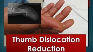 Thumb Dislocation Reduction [upl. by Millian]