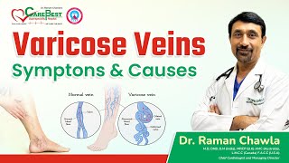 Varicose Veins के लक्षण कारण और निदान  Varicose Veins in Hindi  Dr Raman Chawla [upl. by Merriam847]