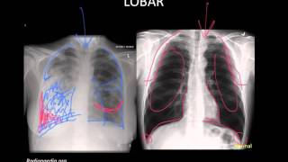 Pneumonia Imaging [upl. by Robinetta]