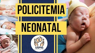 POLICITEMIA NEONATAL [upl. by Estrin601]