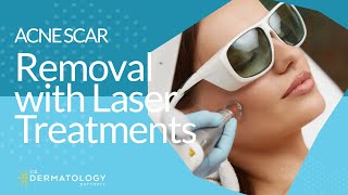 Acne Scar Removal with Laser Treatments [upl. by Noreht]