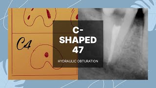 CSHAPED root canal treatment LR7 C4 hydraulic obturation [upl. by Ardnoek671]