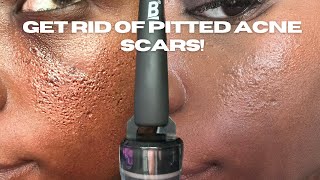 HOW TO GET RID OF PITTED ACNE SCARS [upl. by Anaiq540]