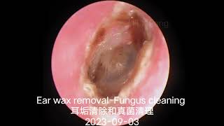 Ear wax removalFungus cleaning 耳垢清除和真菌清理20230903 [upl. by Rehpinej]