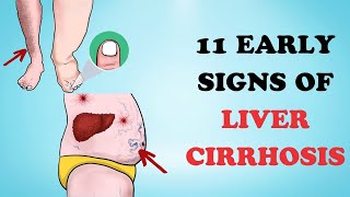 11 Early Signs of Liver Cirrhosis  Healthy Care [upl. by Ipoillak]