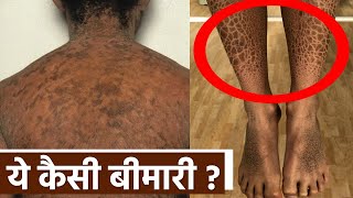 Ichthyosis vulgaris Disease क्या है Symptoms Reason Treatment । Boldsky Health [upl. by Kcirtap]