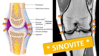 SINOVITE NO JOELHO [upl. by Akinad]