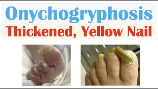 Onychogryphosis Thickened Yellow Nails  Causes Signs amp Symptoms Diagnosis Treatment [upl. by Obie]