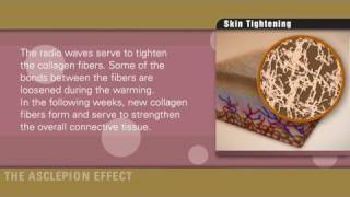 Skin tightening with radiofrequency of Effect systems by Asclepion [upl. by Atekahs]