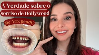 A Verdade Que Ninguém te Conta 4 Anos depois de colocar faceta nos dentes [upl. by Bobbi334]