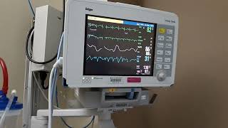 How Read PATIENT MONITOR in Hospital Resp SpO2 Pls HR Arr NBP Alarm Meaning Use Monitoring System [upl. by Cynar324]