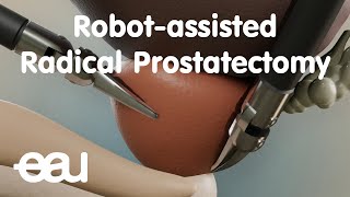 Robotassisted Radical Prostatectomy RARP [upl. by Aicemaj921]