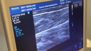 Dry needling under ultrasound [upl. by Loftus120]