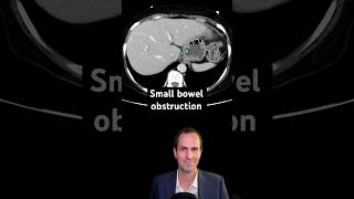 Abdominal CT Tutorials  Small bowel obstruction [upl. by Katzman]