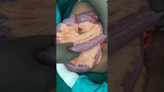 crohn disease  small bowel stricture small bowel resection anatomosis [upl. by Lav103]