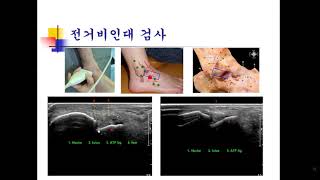 atf sonography [upl. by Yllrebmik]