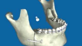 Retroceso de Mandíbula por Prognatismo Mandibular [upl. by Byrle]