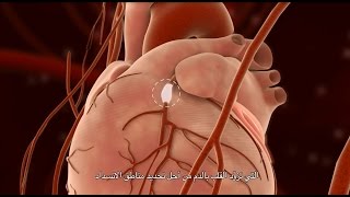 Percutaneous Coronary Intervention PCI [upl. by Adieno]